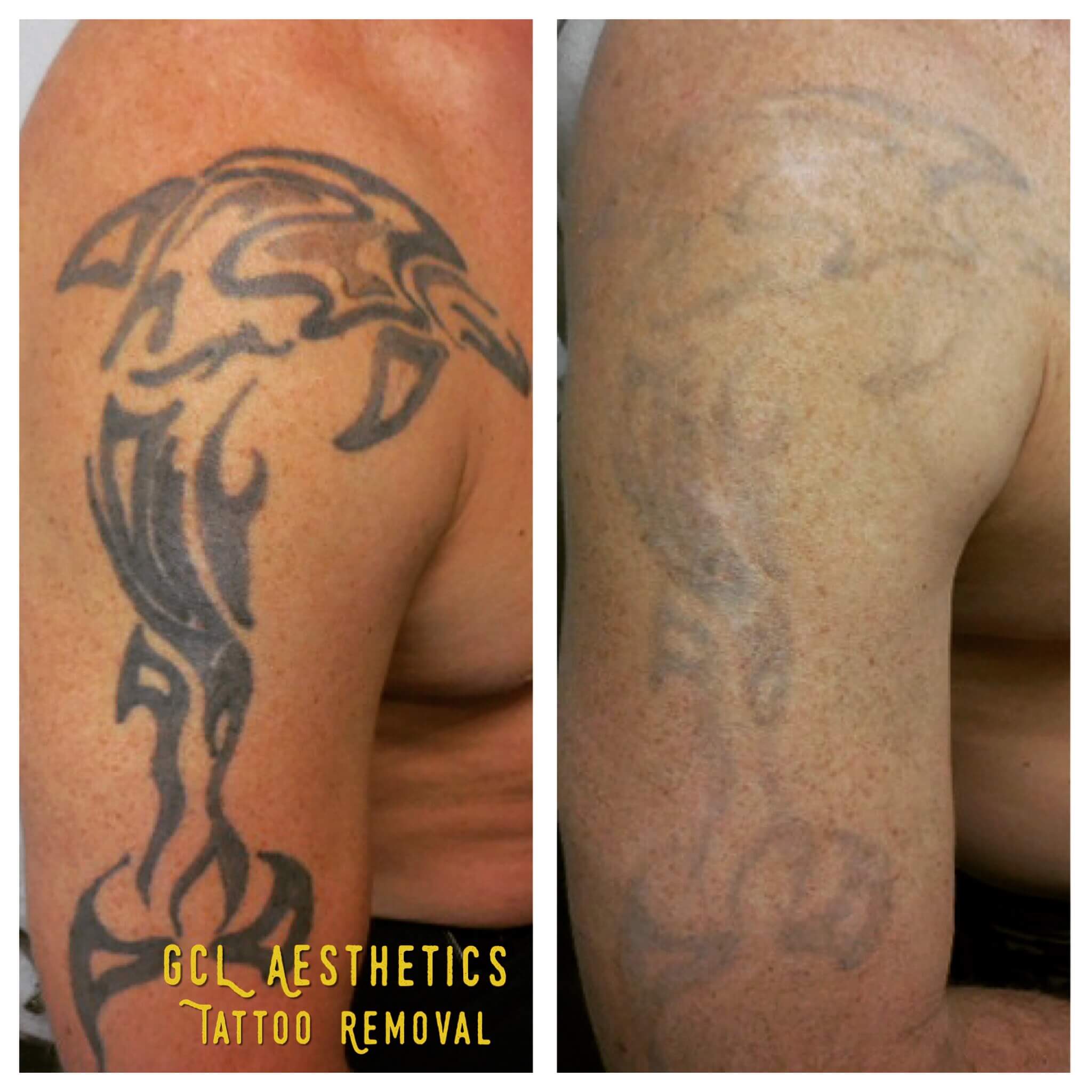 laser tattoo removal long beach